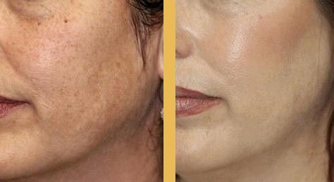 chemical-peel-before-after
